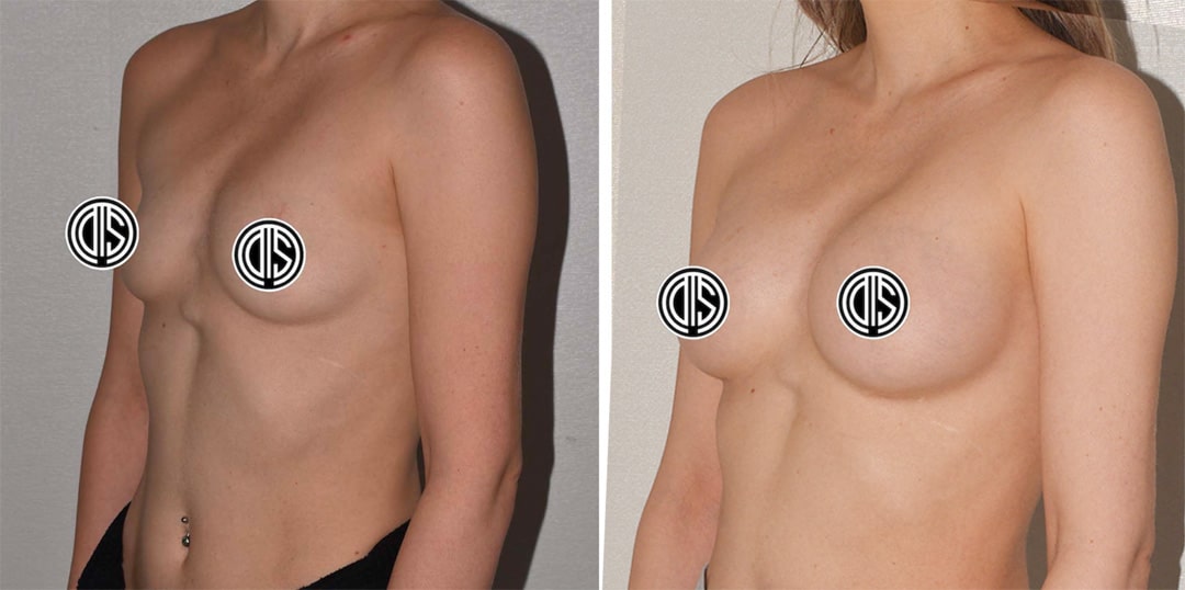 Breast Augmentation -4