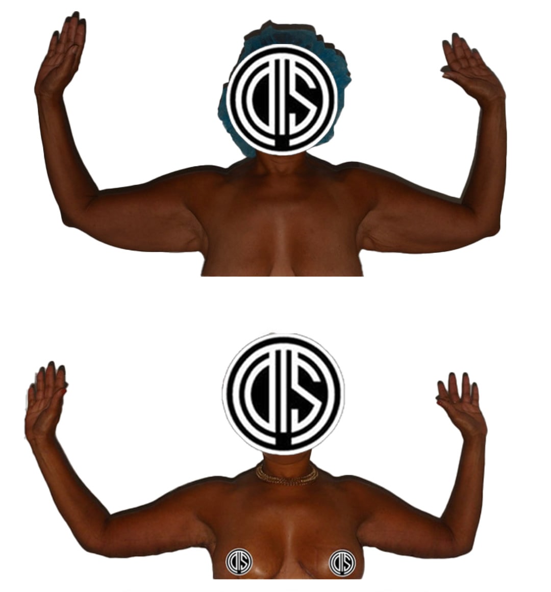 Arm Lift (Brachioplasty)-2