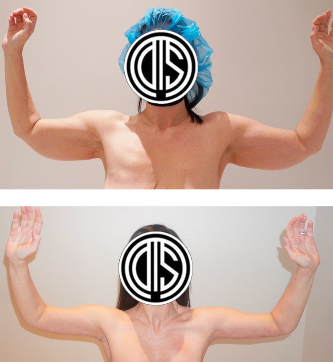 Arm Lift (Brachioplasty)-1