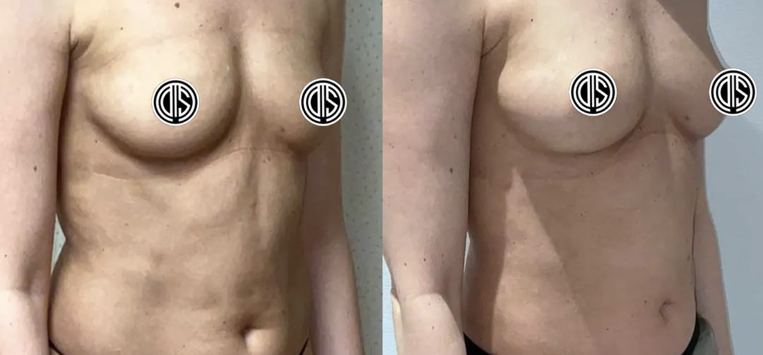 Fat Transfer Breast Augmentation-5