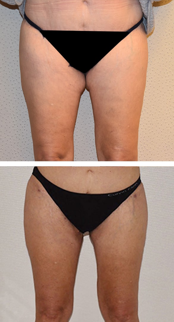 Thigh Lift (Thighplasty)-2