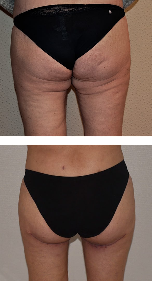 Thigh Lift (Thighplasty)-1