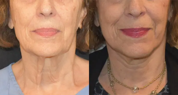 Before and after photo 2