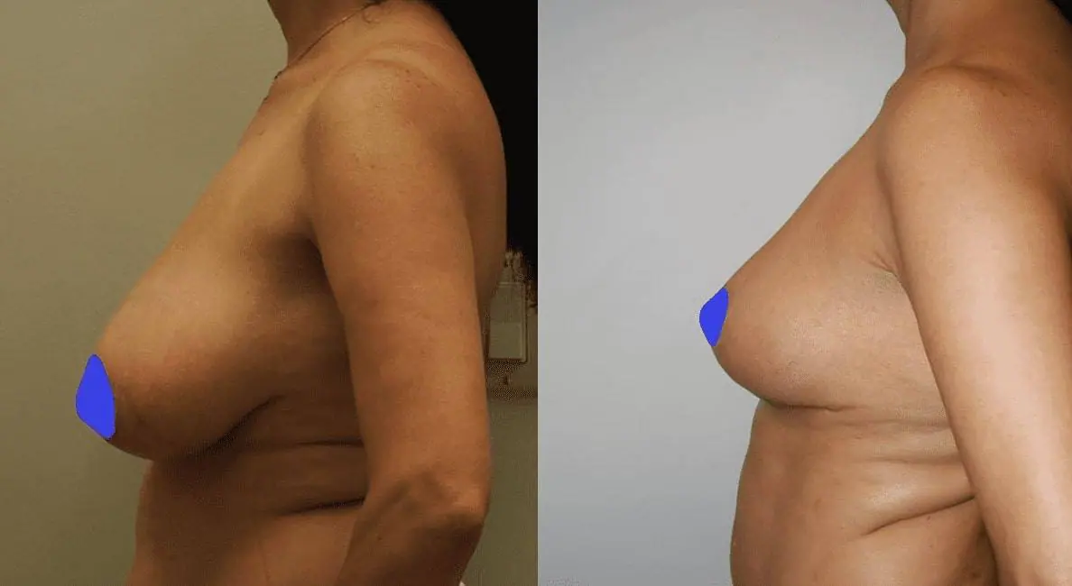 Before and after photo 5
