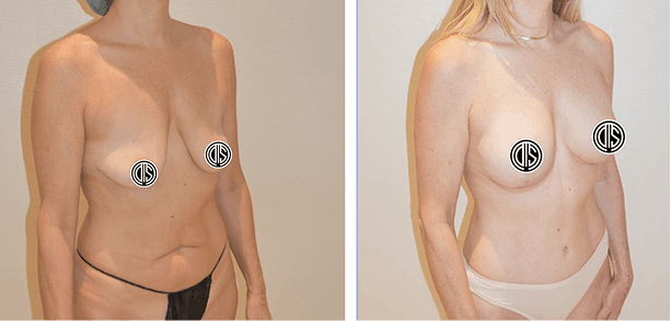 Before and after photo 1